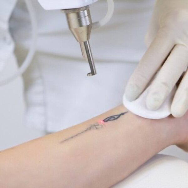 Tattoo Removal in the Context of Relationship Changes