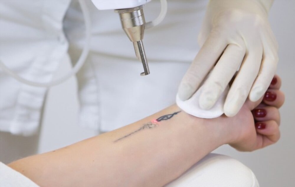 Tattoo Removal in the Context of Relationship Changes